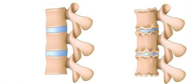 Osteochondral disease in the waist