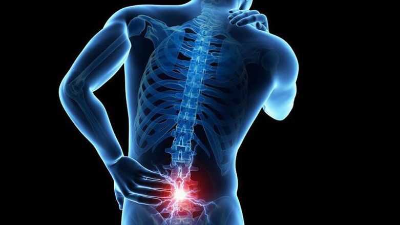 Symptoms of lumbar bone osteochondrosis
